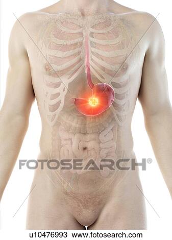 Stomach cancer, conceptual computer illustration. View Large Photo Image Stock Image - Stomach cancer, conceptual computer illustration.. Fotosearch