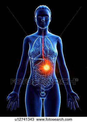 Stomach cancer, conceptual computer illustration. View Large Photo Image Stock Image - Stomach cancer, conceptual computer illustration.. Fotosearch