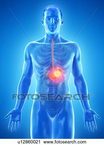 Stock Image - Stomach cancer, conceptual computer illustration.. Fotosearch