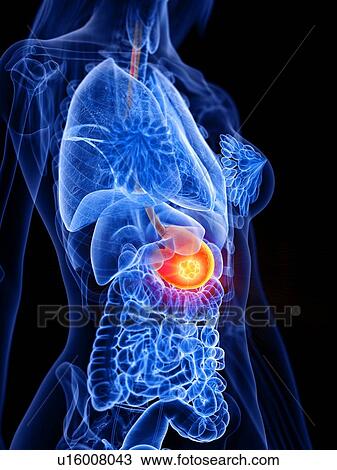 Stock Image - Stomach cancer, conceptual illustration. Fotosearch