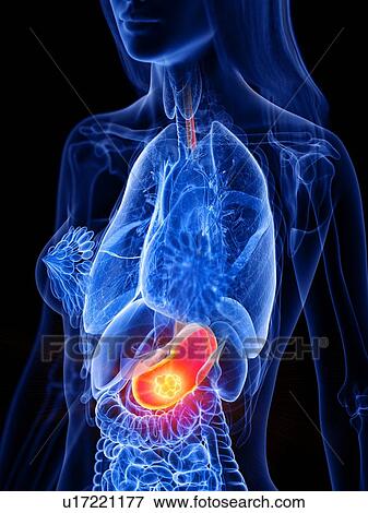Stomach cancer, conceptual illustration View Large Photo Image Stock Photo - Stomach cancer, conceptual illustration. Fotosearch