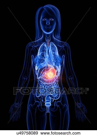 Stomach cancer, conceptual illustration View Large Photo Image Stock Photo - Stomach cancer, conceptual illustration. Fotosearch