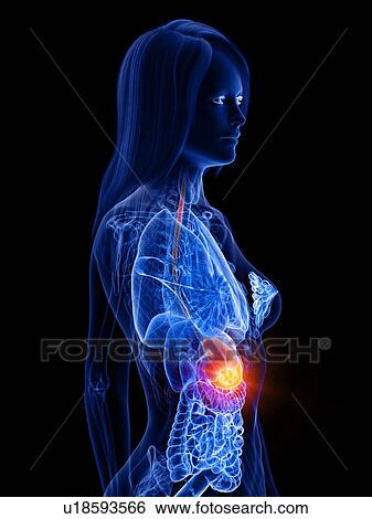 Stomach cancer, conceptual illustration View Large Photo Image Stock Photograph - Stomach cancer, conceptual illustration. Fotosearch