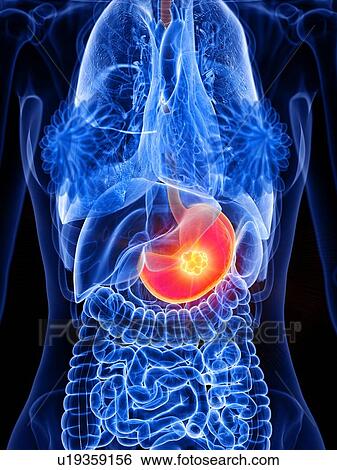 Stomach cancer, conceptual illustration View Large Photo Image Stock Photograph - Stomach cancer, conceptual illustration. Fotosearch