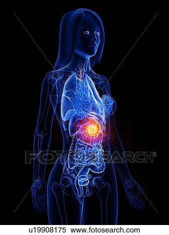 Stock Photography - Stomach cancer, conceptual illustration. Fotosearch