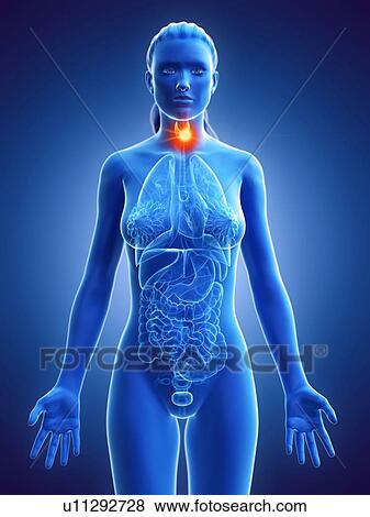 Stock Photo - Thyroid cancer, conceptual computer illustration.. Fotosearch
