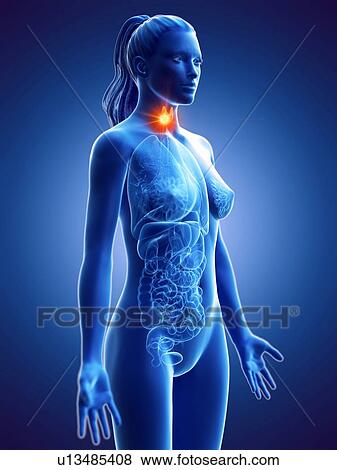 Stock Photo - Thyroid cancer, conceptual computer illustration.. Fotosearch