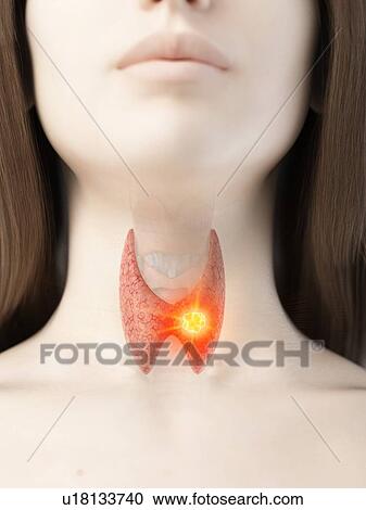 Thyroid cancer, conceptual illustration View Large Photo Image Stock Image - Thyroid cancer, conceptual illustration. Fotosearch