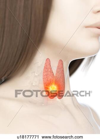 Thyroid cancer, conceptual illustration View Large Photo Image Stock Image - Thyroid cancer, conceptual illustration. Fotosearch
