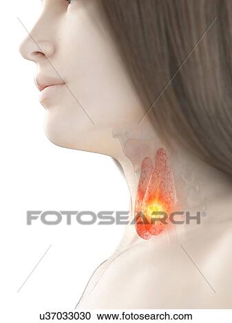 Thyroid cancer, conceptual illustration View Large Photo Image Stock Image - Thyroid cancer, conceptual illustration. Fotosearch