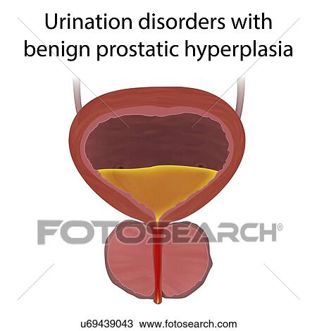 Urinary disorders with benign prostatic hyperplasia, illustration. View Large Photo Image Stock Image - Urinary disorders with benign prostatic hyperplasia, illustration.. Fotosearch