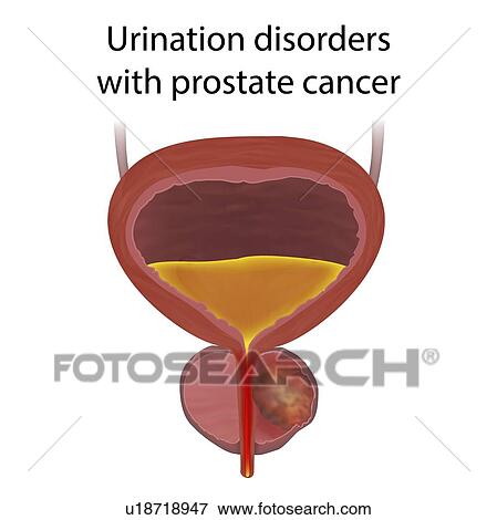 Stock Photo - Urinary disorders with prostate cancer, illustration.. Fotosearch