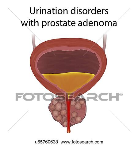 Stock Photo - Urinary disorders with prostate gland adenoma, illustration.. Fotosearch