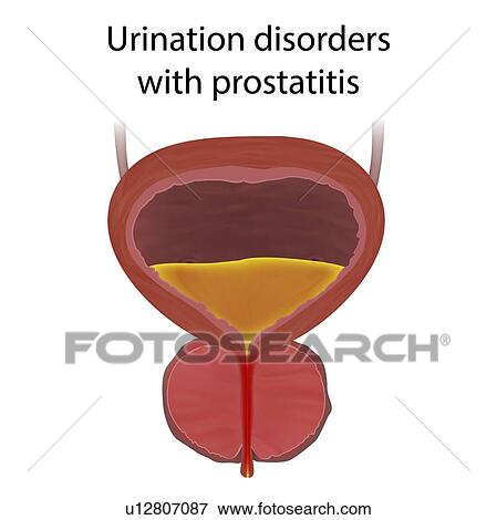 Stock Photo - Urinary disorders with prostatitis, illustration.. Fotosearch