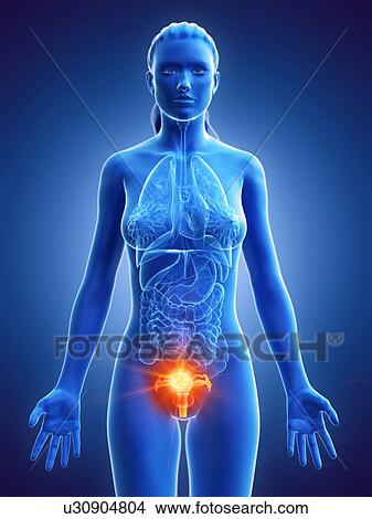 Uterine cancer, conceptual computer illustration. View Large Photo Image Picture - Uterine cancer, conceptual computer illustration.. Fotosearch
