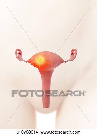 Picture - Uterine cancer, conceptual illustration. Fotosearch