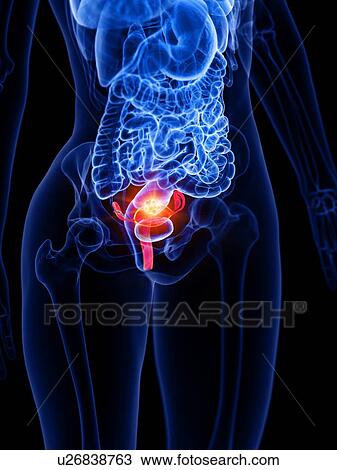 Uterine cancer, conceptual illustration View Large Photo Image Stock Image - Uterine cancer, conceptual illustration. Fotosearch