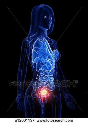 Uterine cancer, conceptual illustration View Large Photo Image Stock Photo - Uterine cancer, conceptual illustration. Fotosearch