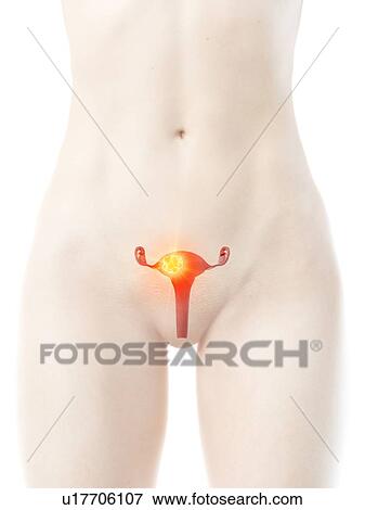 Stock Photo - Uterine cancer, conceptual illustration. Fotosearch