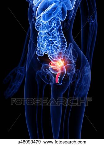 Uterine cancer, conceptual illustration View Large Photo Image Stock Photo - Uterine cancer, conceptual illustration. Fotosearch