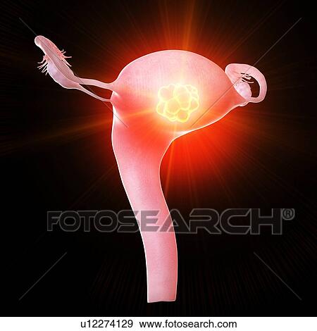 Stock Photo - Uterine tumour, conceptual computer illustration.. Fotosearch