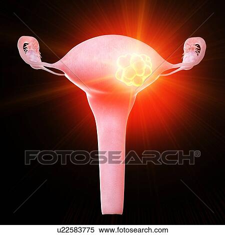 Uterine tumour, conceptual computer illustration. View Large Photo Image Stock Photography - Uterine tumour, conceptual computer illustration.. Fotosearch