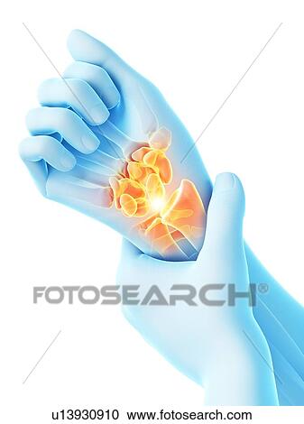 Stock Image - Wrist pain, conceptual illustration.. Fotosearch