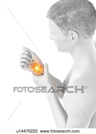 Wrist pain, conceptual illustration. View Large Photo Image Stock Image - Wrist pain, conceptual illustration.. Fotosearch