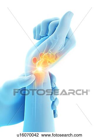 Stock Image - Wrist pain, conceptual illustration.. Fotosearch