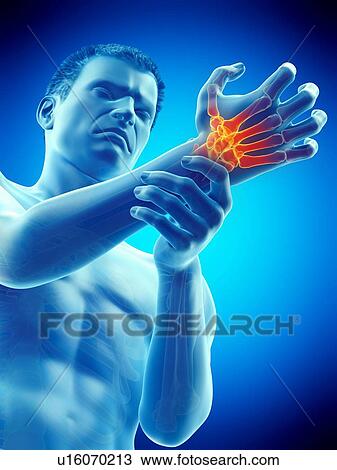 Wrist pain, conceptual illustration. View Large Photo Image Stock Image - Wrist pain, conceptual illustration.. Fotosearch