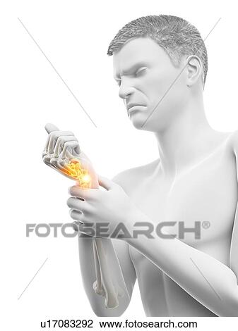 Stock Image - Wrist pain, conceptual illustration.. Fotosearch