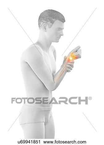 Wrist pain, conceptual illustration. View Large Photo Image Stock Image - Wrist pain, conceptual illustration.. Fotosearch