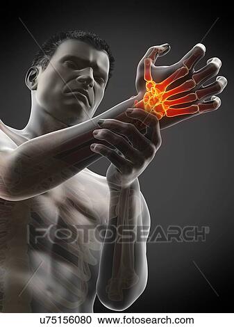 Stock Image - Wrist pain, conceptual illustration.. Fotosearch
