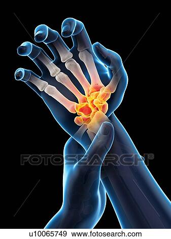Stock Photo - Wrist pain, conceptual illustration.. Fotosearch
