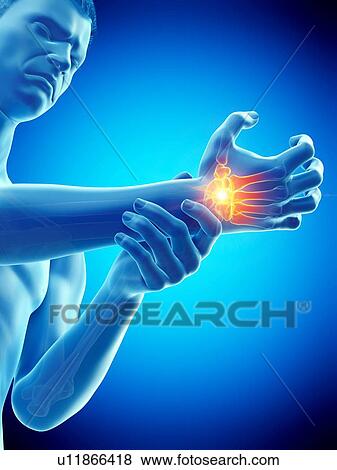 Wrist pain, conceptual illustration. View Large Photo Image Stock Photo - Wrist pain, conceptual illustration.. Fotosearch