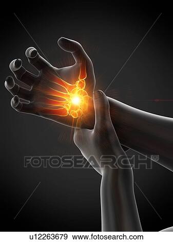 Stock Photo - Wrist pain, conceptual illustration.. Fotosearch