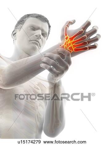 Wrist pain, conceptual illustration. View Large Photo Image Stock Photo - Wrist pain, conceptual illustration.. Fotosearch