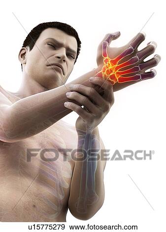 Stock Photo - Wrist pain, conceptual illustration.. Fotosearch