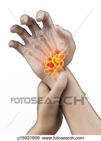 Stock Photo - Wrist pain, conceptual illustration.. Fotosearch