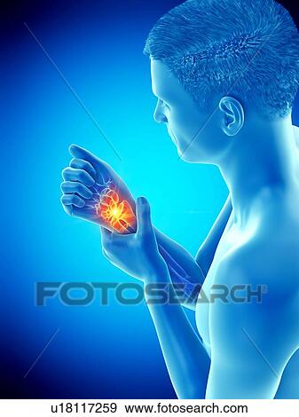 Wrist pain, conceptual illustration. View Large Photo Image Stock Photo - Wrist pain, conceptual illustration.. Fotosearch