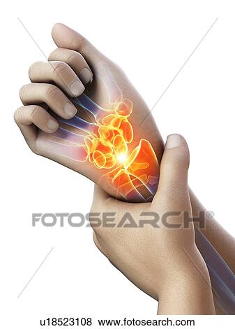 Wrist pain, conceptual illustration. View Large Photo Image Stock Photo - Wrist pain, conceptual illustration.. Fotosearch
