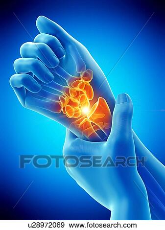 Wrist pain, conceptual illustration. View Large Photo Image Stock Photo - Wrist pain, conceptual illustration.. Fotosearch