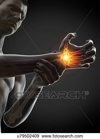 Wrist pain, conceptual illustration. View Large Photo Image Stock Photo - Wrist pain, conceptual illustration.. Fotosearch