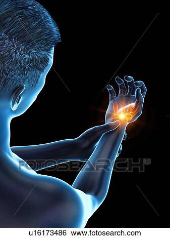 Stock Photograph - Wrist pain, conceptual illustration.. Fotosearch