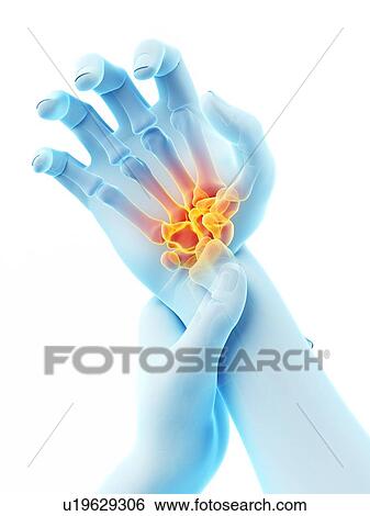 Stock Photograph - Wrist pain, conceptual illustration.. Fotosearch