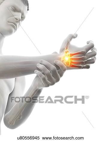 Wrist pain, conceptual illustration. View Large Photo Image Stock Photography - Wrist pain, conceptual illustration.. Fotosearch