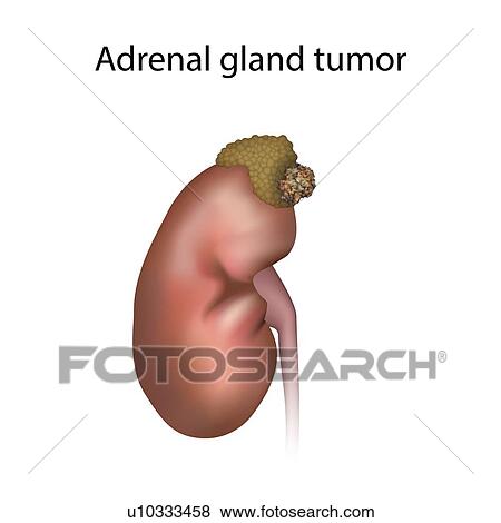 Adrenal gland tumour, illustration View Large Photo Image Stock Photo - Adrenal gland tumour, illustration. Fotosearch