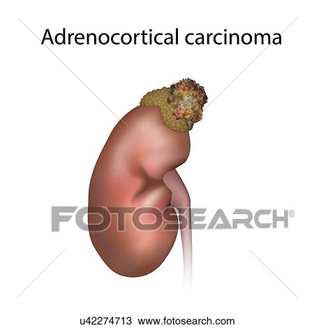 Stock Image - Adrenocortical carcinoma, illustration. Fotosearch