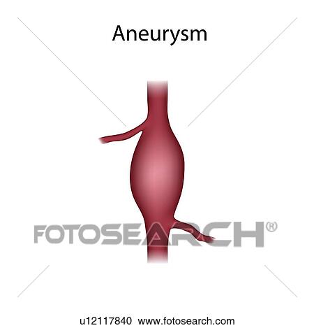 Aneurysm, illustration View Large Photo Image Stock Image - Aneurysm, illustration. Fotosearch