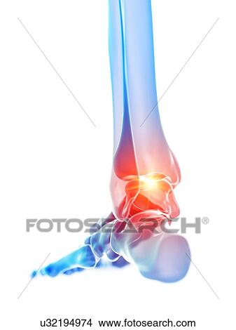 Picture - Ankle pain, illustration. Fotosearch